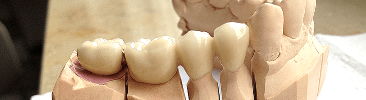 Kronen und Brücken sind die gängigste Art, verloren gegangene oder beschädigte Zähne zu ersetzen und die Kaufunktion, Ästhetik und Phonetik wieder herzustellen.